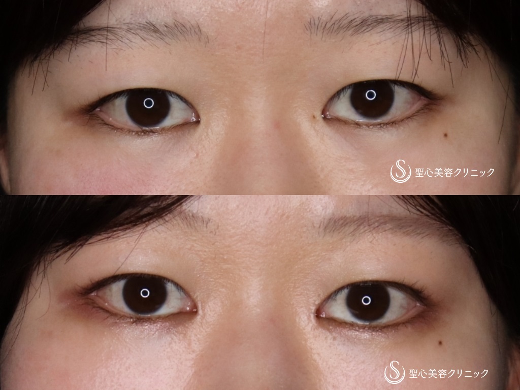 【20代女性・傷の目立ちにくいリドレープ法】目頭切開（1か月後） After 