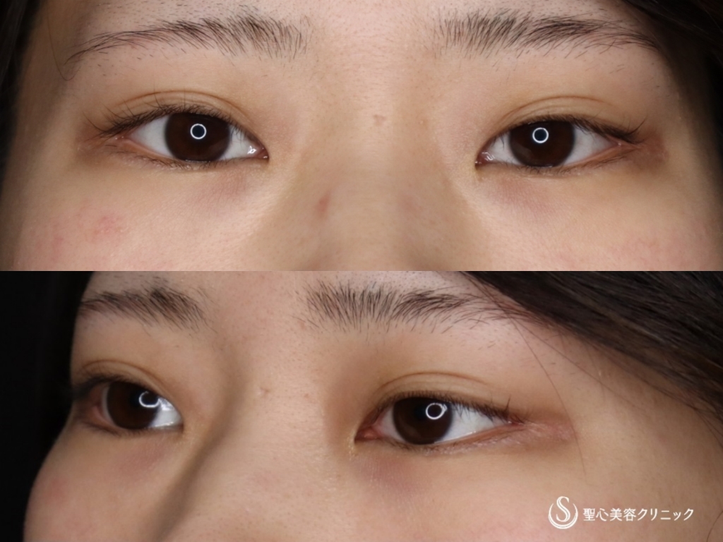 【20代女性・自然なたれ目にしたい】たれ目形成 切開法(グラマラスライン)(1か月後) - 症例写真 - 美容整形、美容外科なら聖心美容クリニック