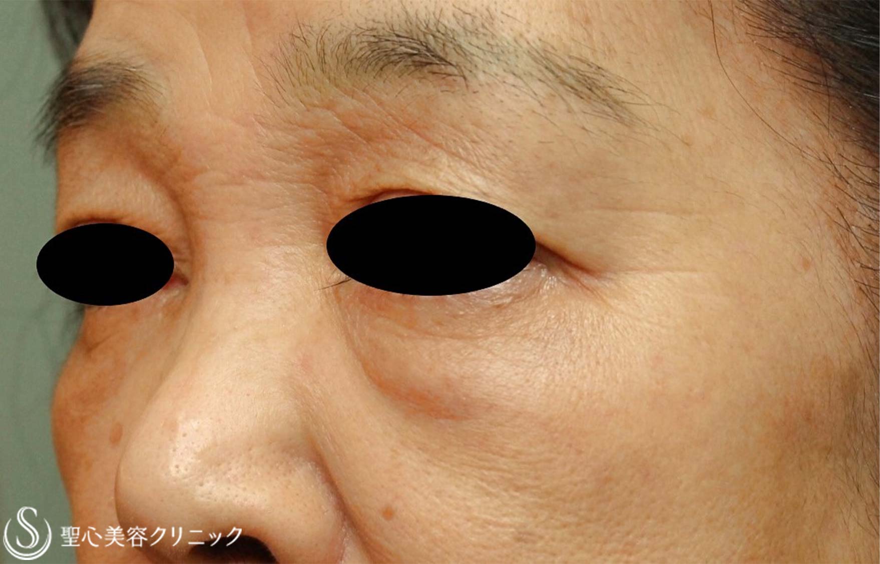 【70代女性・目の下のくま】左下眼瞼除皺術（筋皮弁法）（術後7年） Before 