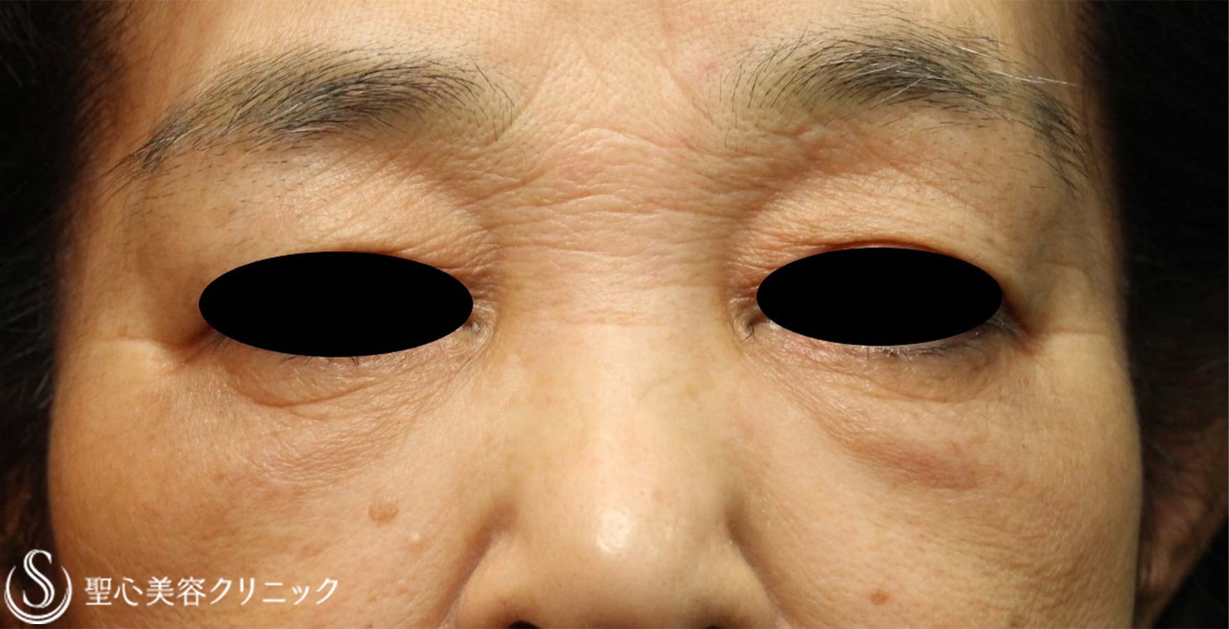 【70代女性・目の下のくま】左下眼瞼除皺術（筋皮弁法）（術後7年） Before 