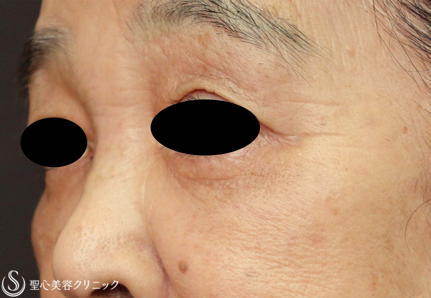 【70代女性・目の下のくま】左下眼瞼除皺術（筋皮弁法）（術後7年） After 