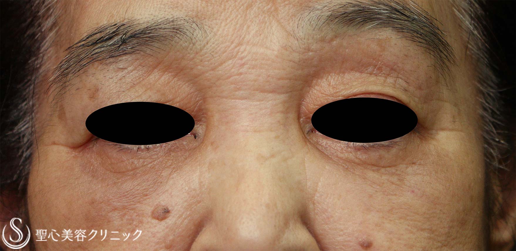 【70代女性・目の下のくま】左下眼瞼除皺術（筋皮弁法）（術後7年） After 