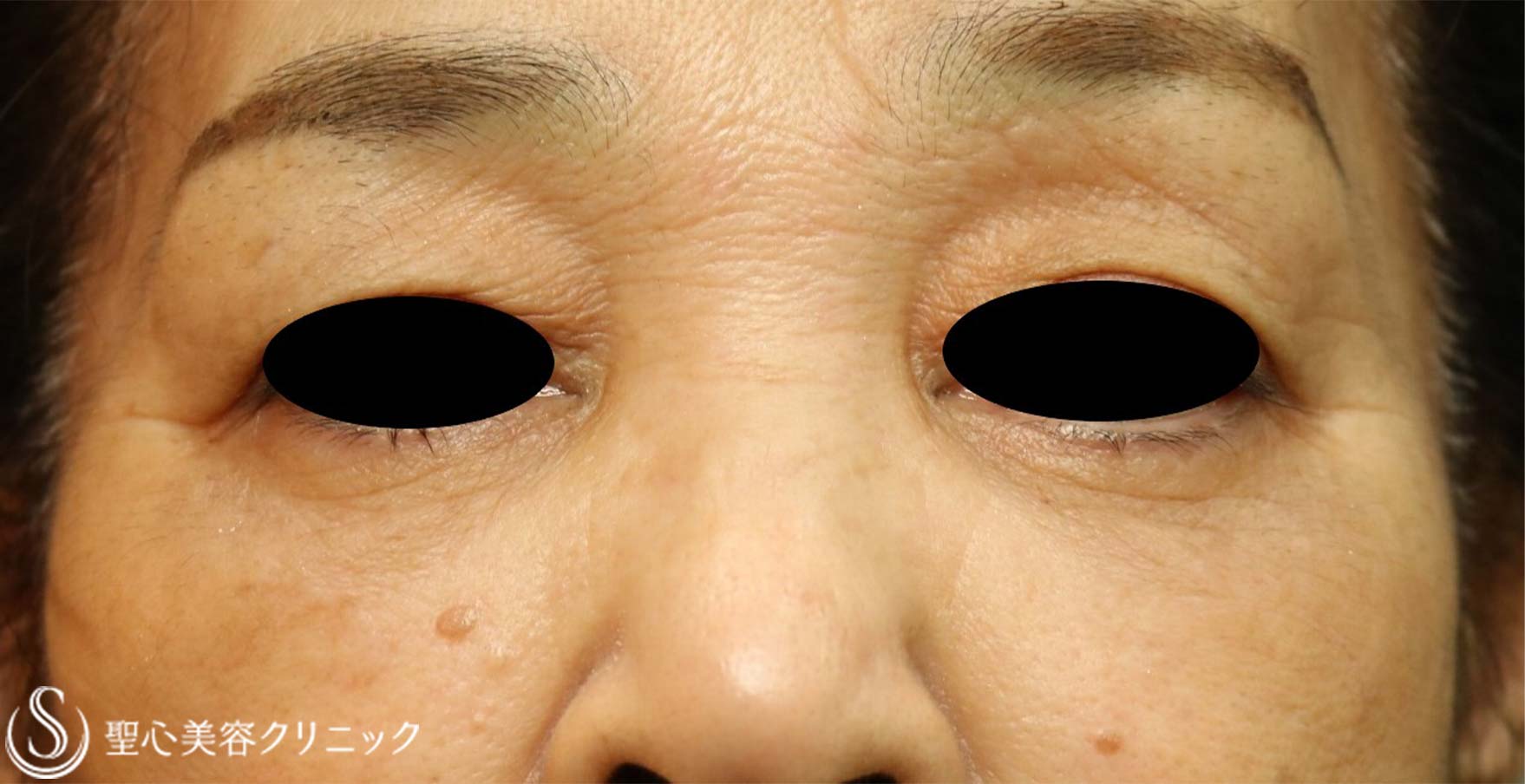 【70代女性・目の下のくま】左下眼瞼除皺術（筋皮弁法）（術後7年） After 