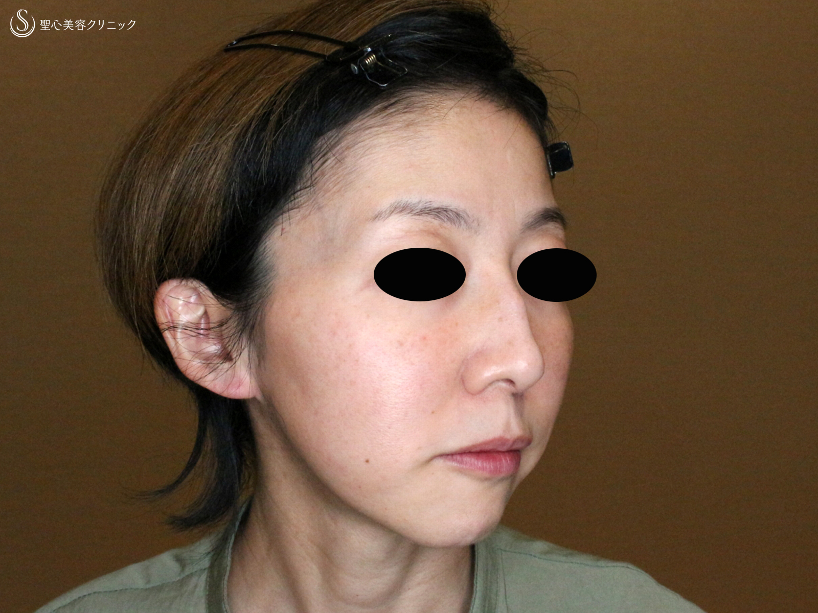 【46歳女性・最新リフト小顔マシン先行体験モニター】DENSITY「デンシティ」（1ヶ月後） After 