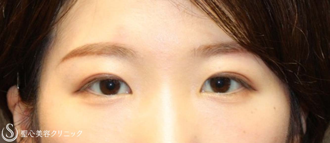 【20代女性・ナチュラルな目元に】二重術（埋没法）：マイクロメソッド+α（術後3ヶ月） After 