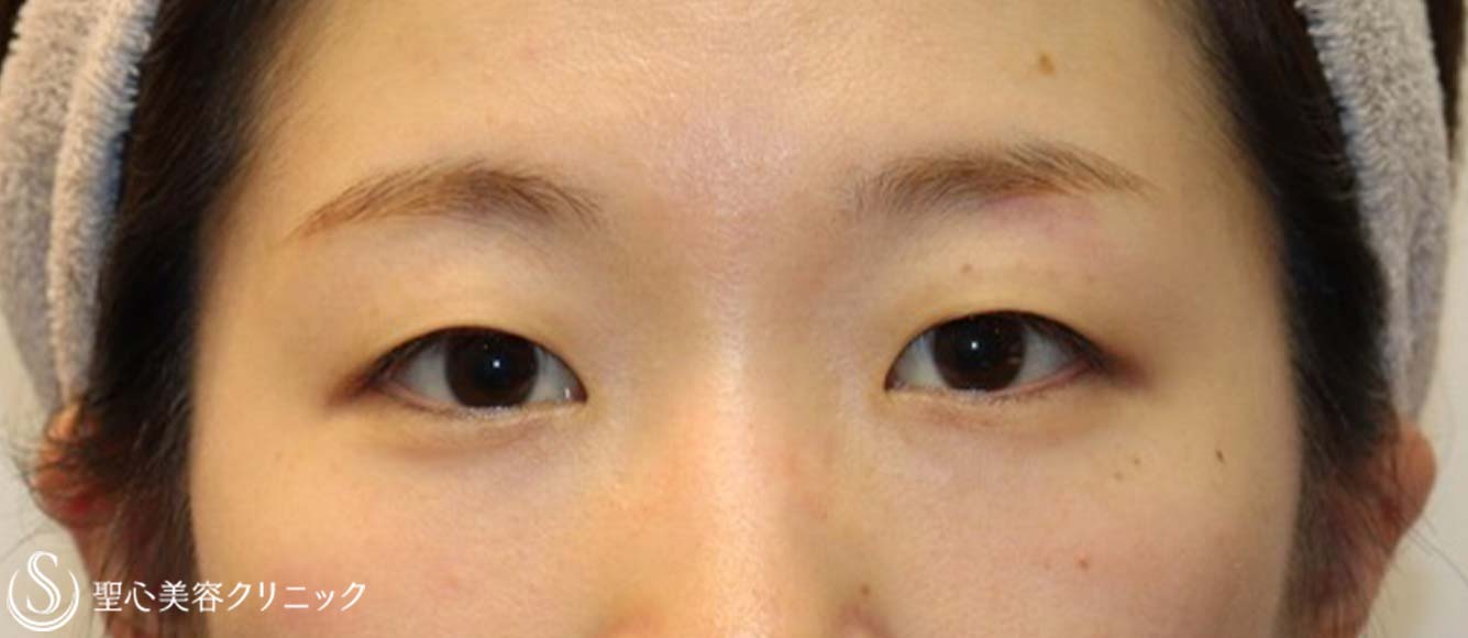 【20代女性・ナチュラルな目元に】二重術（埋没法）：マイクロメソッド+α（術後3ヶ月） Before 