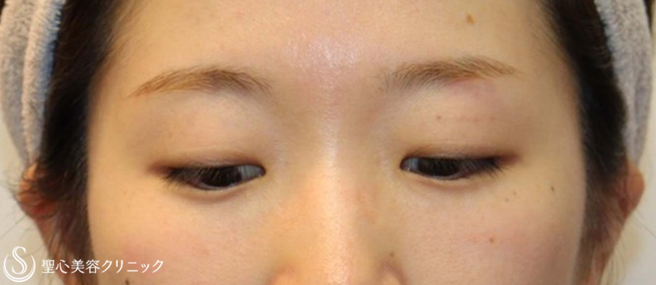 【20代女性・ナチュラルな目元に】二重術（埋没法）：マイクロメソッド+α（術後3ヶ月） Before 