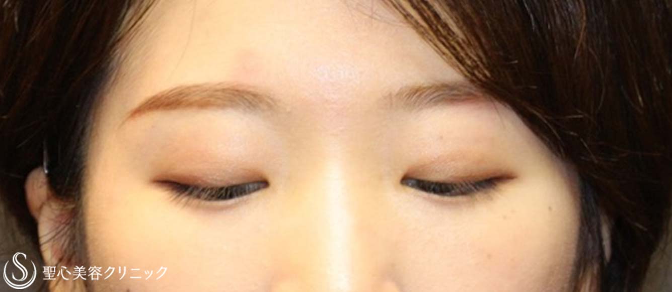【20代女性・ナチュラルな目元に】二重術（埋没法）：マイクロメソッド+α（術後3ヶ月） After 