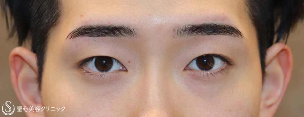 【20代男性・キリッとしたナチュラルな二重に】二重術（埋没法）：マイクロメソッド+α（術後1ヶ月） Before 