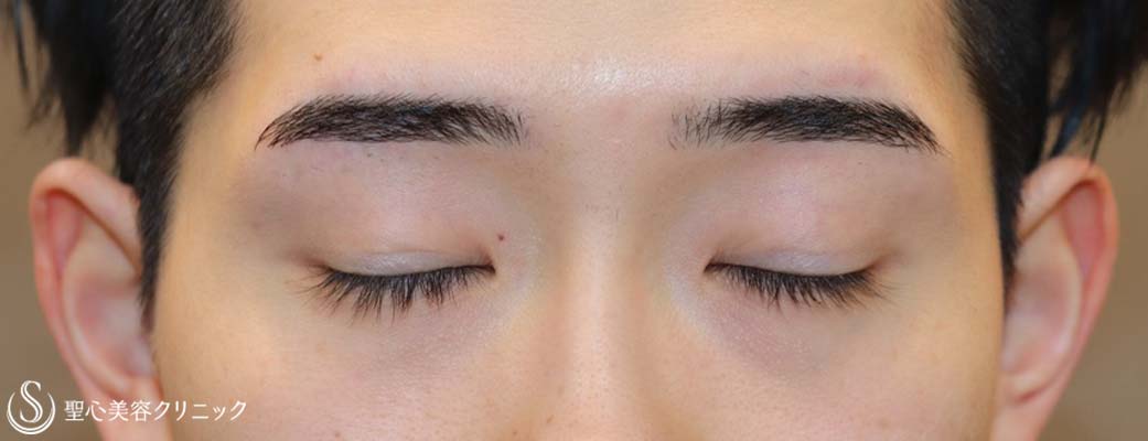 【20代男性・キリッとしたナチュラルな二重に】二重術（埋没法）：マイクロメソッド+α（術後1ヶ月） Before 