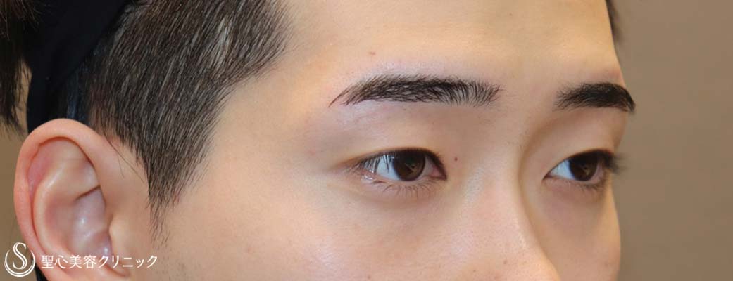 【20代男性・キリッとしたナチュラルな二重に】二重術（埋没法）：マイクロメソッド+α（術後1ヶ月） Before 
