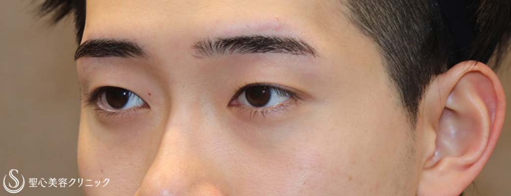【20代男性・キリッとしたナチュラルな二重に】二重術（埋没法）：マイクロメソッド+α（術後1ヶ月） Before 