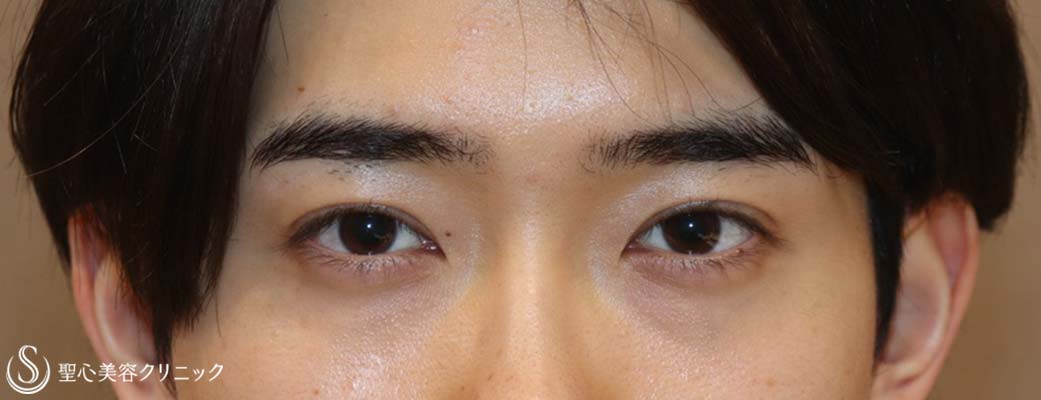 【20代男性・キリッとしたナチュラルな二重に】二重術（埋没法）：マイクロメソッド+α（術後1ヶ月） After 