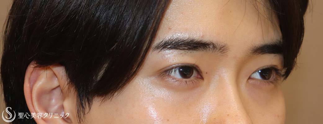 【20代男性・キリッとしたナチュラルな二重に】二重術（埋没法）：マイクロメソッド+α（術後1ヶ月） After 