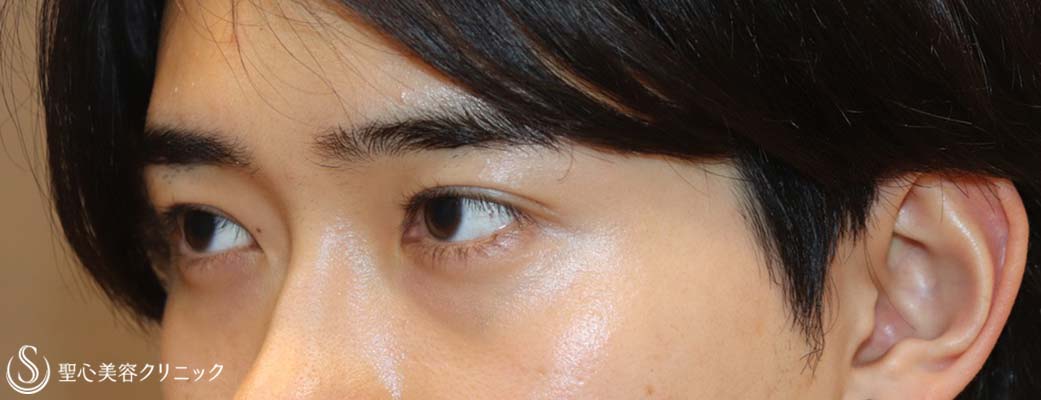 【20代男性・キリッとしたナチュラルな二重に】二重術（埋没法）：マイクロメソッド+α（術後1ヶ月） After 