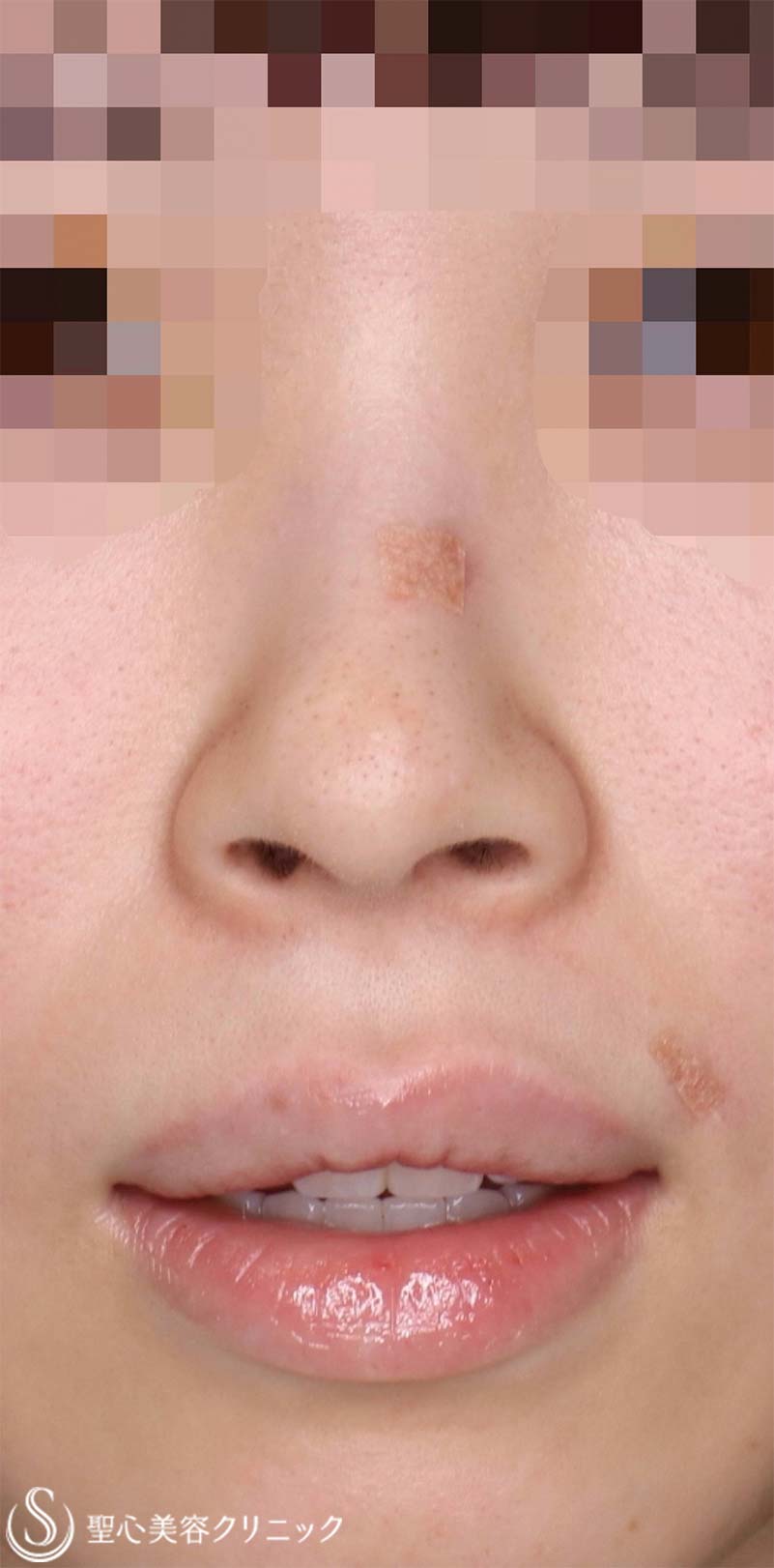 【20代女性・人中をバランスよくできるだけ短くしたい！！小鼻をナチュラルに小さくしたい！！】プレミアムリップリフト（プレミアム人中短縮術）＋小鼻縮小術（内側法）（術後3ヶ月） Before 