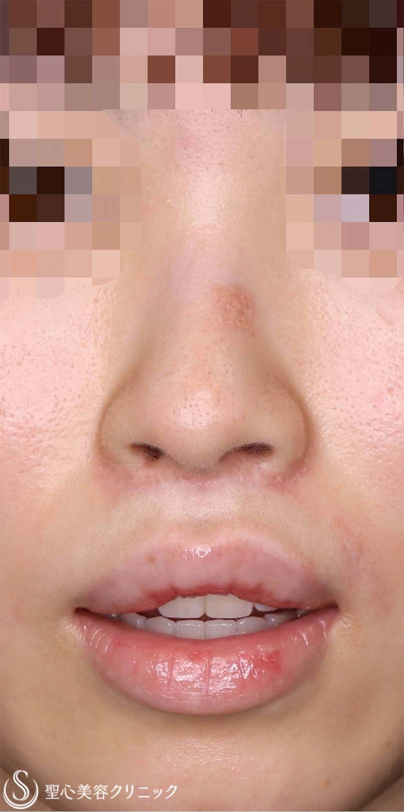 【20代女性・人中をバランスよくできるだけ短くしたい！！小鼻をナチュラルに小さくしたい！！】プレミアムリップリフト（プレミアム人中短縮術）＋小鼻縮小術（内側法）（術後3ヶ月） After 