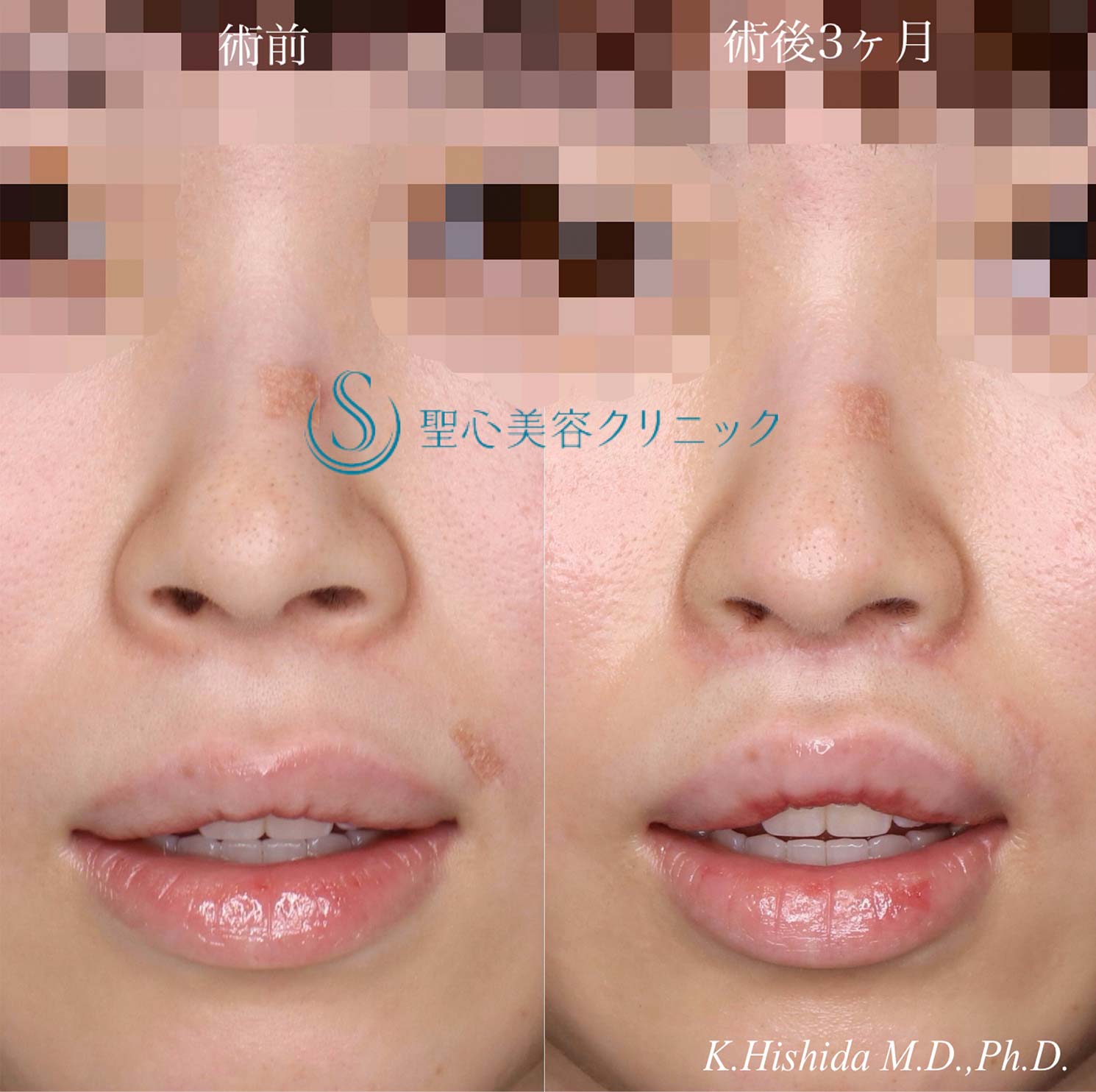 【20代女性・人中をバランスよくできるだけ短くしたい！！小鼻をナチュラルに小さくしたい！！】プレミアムリップリフト（プレミアム人中短縮術）＋小鼻縮小術（内側法）（術後3ヶ月） After 