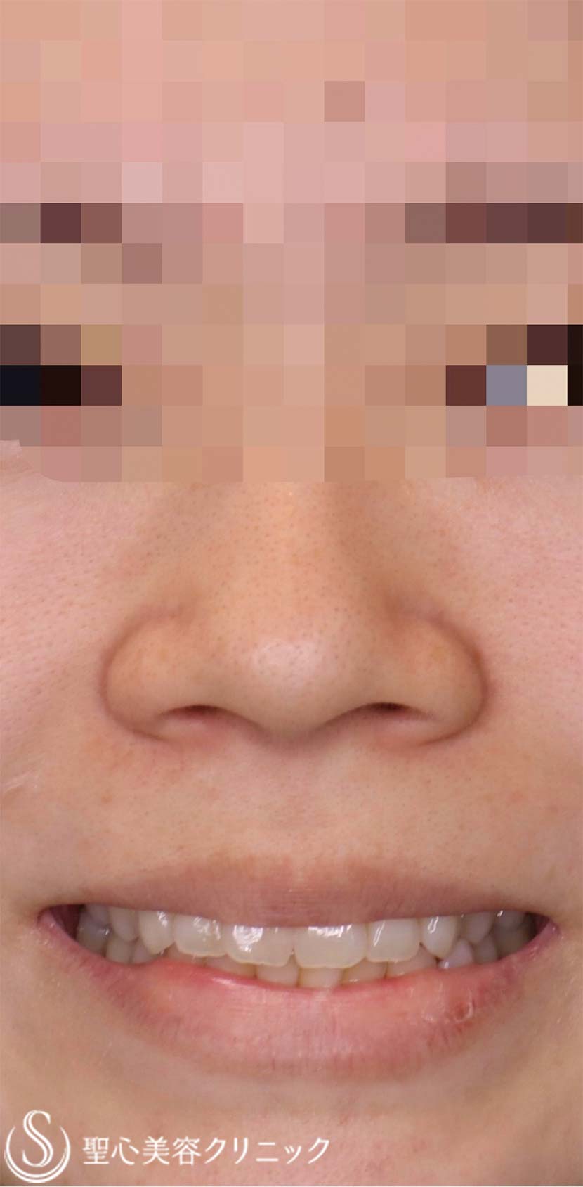 【20代女性・整形感が出ないように小鼻を小さくしたい！！笑った時に小鼻が広がらないようにしたい！！】小鼻縮小術＋側頭筋膜移植（術後1年4ヶ月） Before 