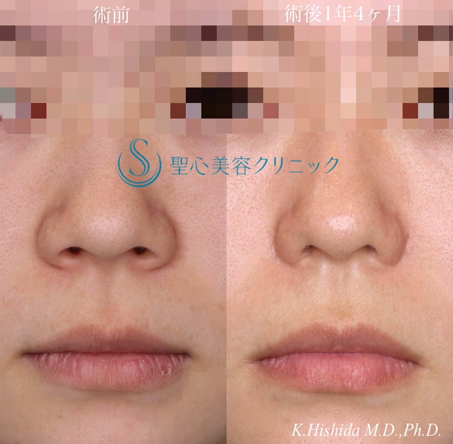 【20代女性・整形感が出ないように小鼻を小さくしたい！！笑った時に小鼻が広がらないようにしたい！！】小鼻縮小術＋側頭筋膜移植（術後1年4ヶ月） After 