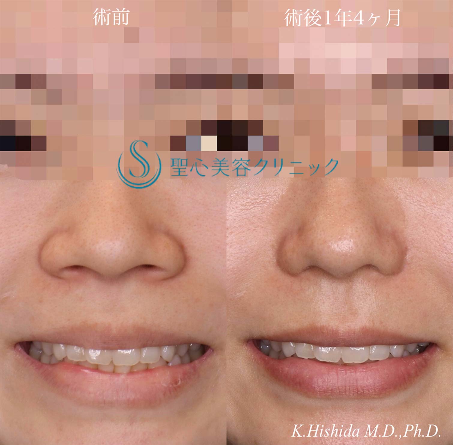 【20代女性・整形感が出ないように小鼻を小さくしたい！！笑った時に小鼻が広がらないようにしたい！！】小鼻縮小術＋側頭筋膜移植（術後1年4ヶ月） After 