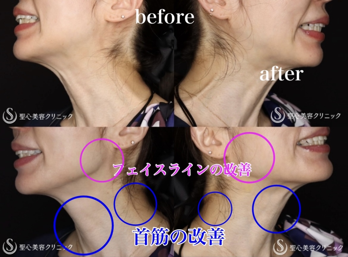 【50代女性・たるみ予防】ボトックスリフト（2週間後） After 