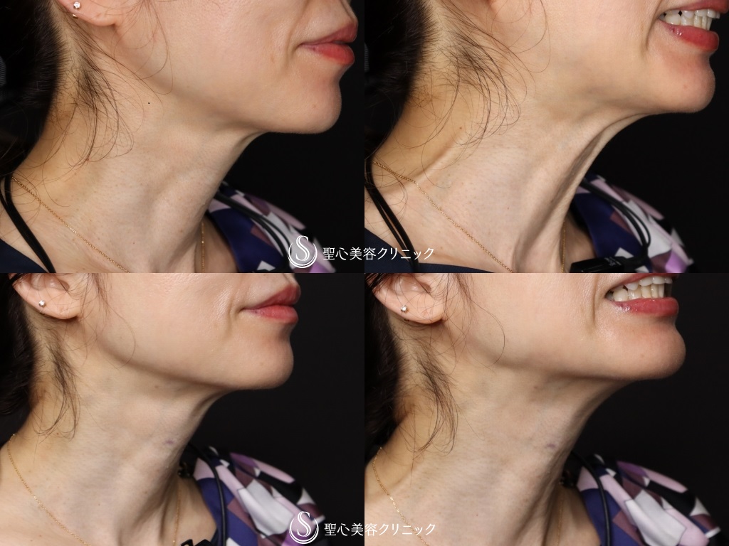 【50代女性・たるみ予防】ボトックスリフト（2週間後） After 