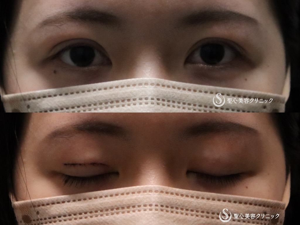 【20代女性・左右対称の二重に】他院二重修正（右目二重切開法）（１か月後） After 