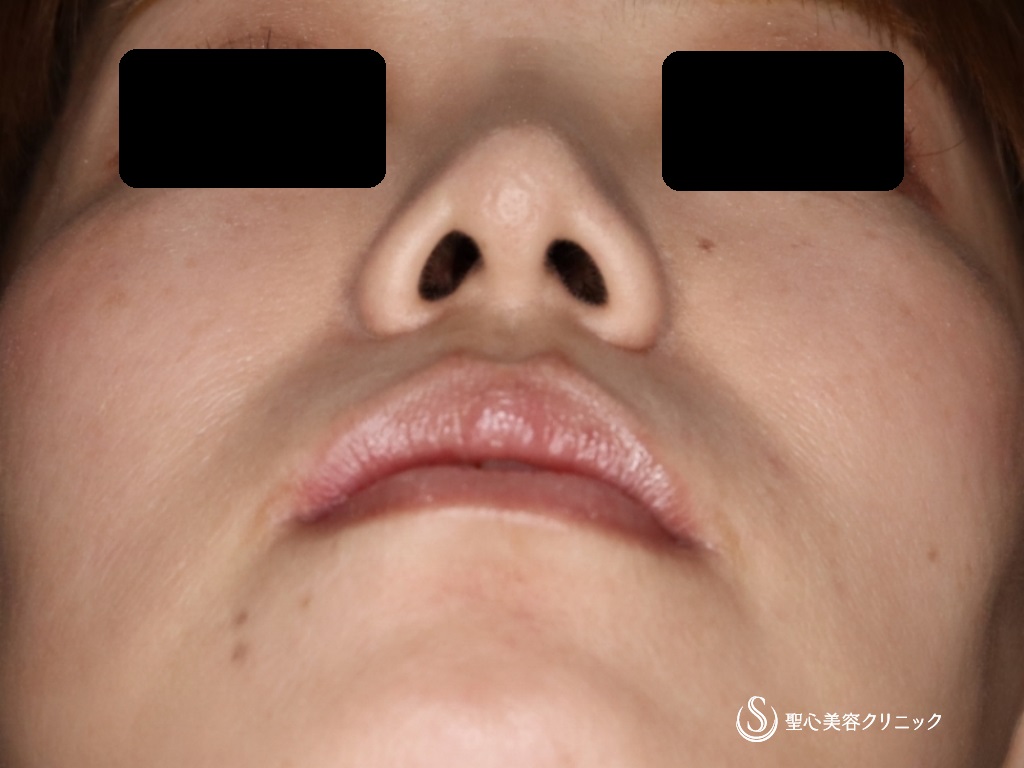 【40代女性・鼻先を細くして形を整えたい】鼻尖縮小＋鼻尖形成（耳介軟骨移植）（1か月後） After 
