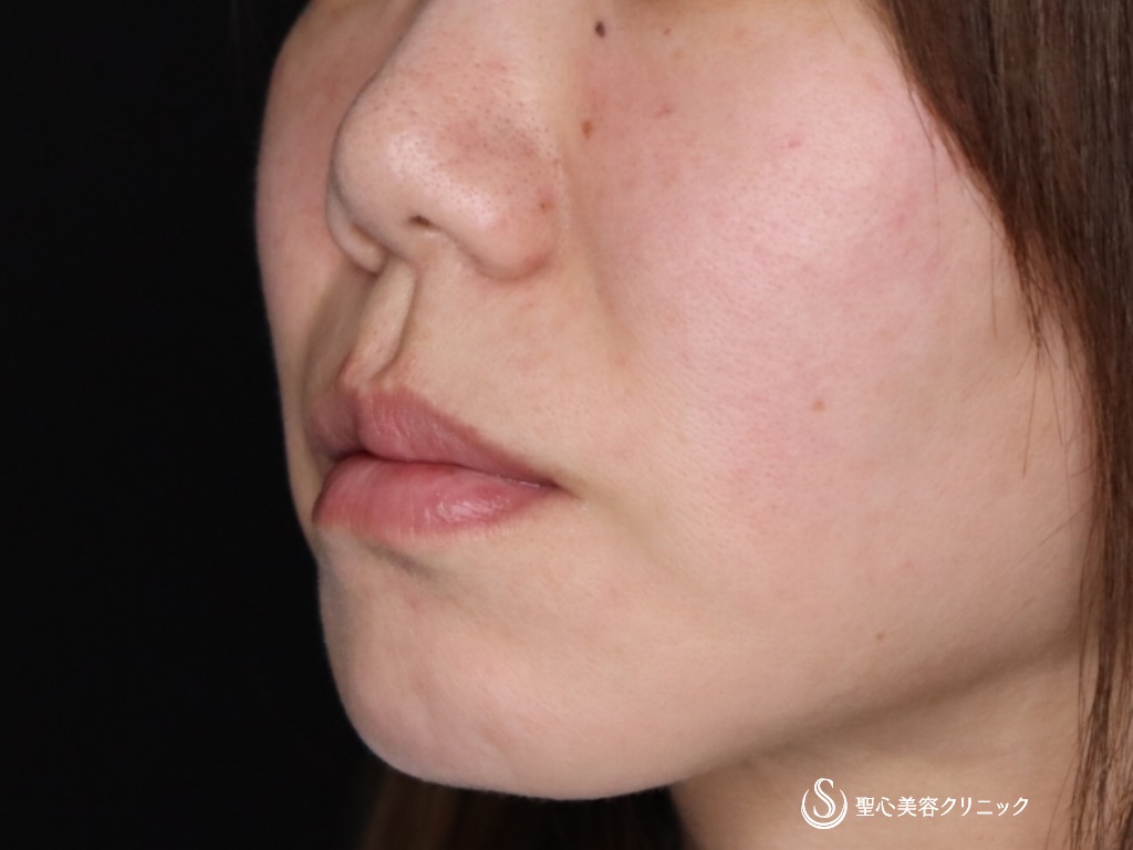 【40代女性・鼻先を細くして形を整えたい】鼻尖縮小＋鼻尖形成（耳介軟骨移植）（1か月後） Before 