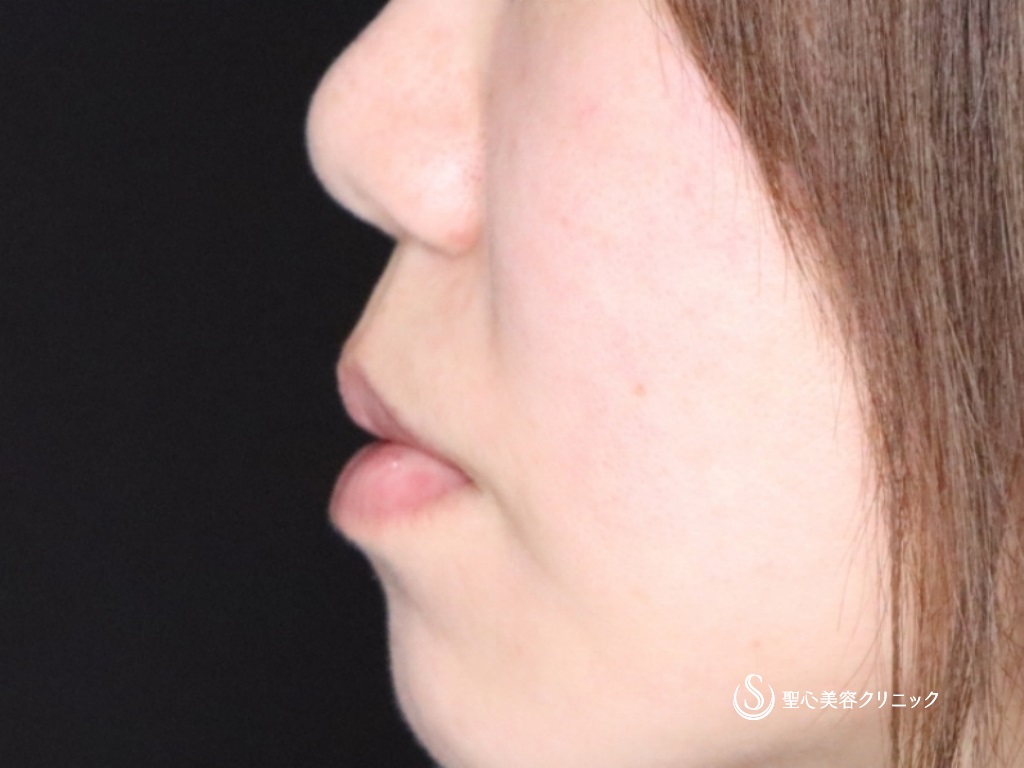 【40代女性・鼻先を細くして形を整えたい】鼻尖縮小＋鼻尖形成（耳介軟骨移植）（1か月後） Before 