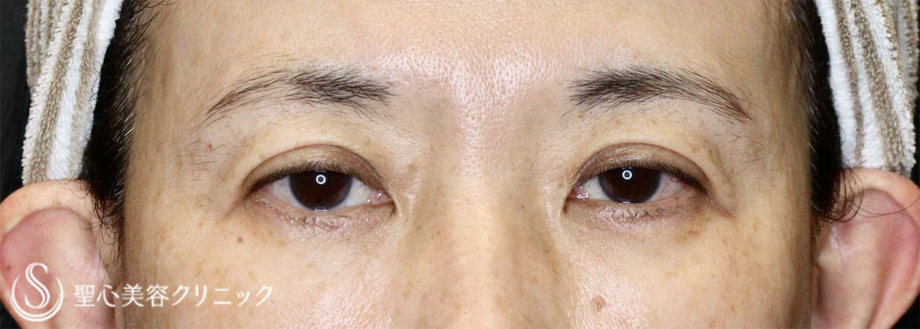 【50代女性・眼瞼下垂手術で目の開きを改善】眼瞼下垂（切開法/挙筋前転法）（手術直後、3ヶ月後） Before 