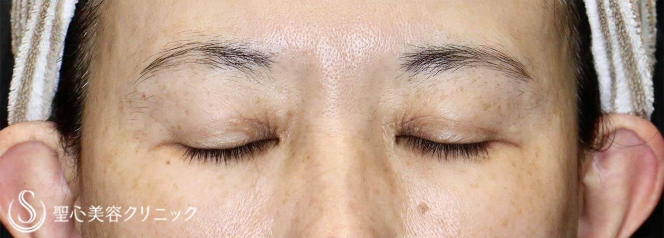 【50代女性・眼瞼下垂手術で目の開きを改善】眼瞼下垂（切開法/挙筋前転法）（手術直後、3ヶ月後） Before 