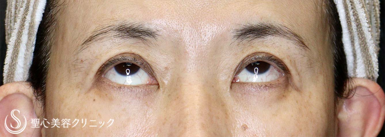 【50代女性・眼瞼下垂手術で目の開きを改善】眼瞼下垂（切開法/挙筋前転法）（手術直後、3ヶ月後） Before 
