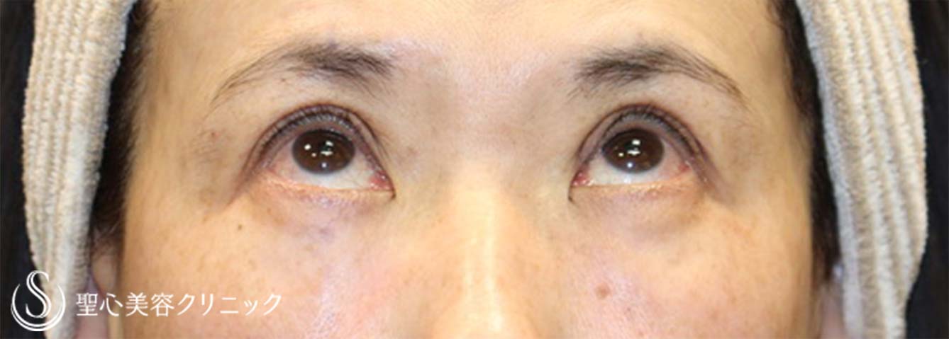 【50代女性・眼瞼下垂手術で目の開きを改善】眼瞼下垂（切開法/挙筋前転法）（手術直後、3ヶ月後） After 
