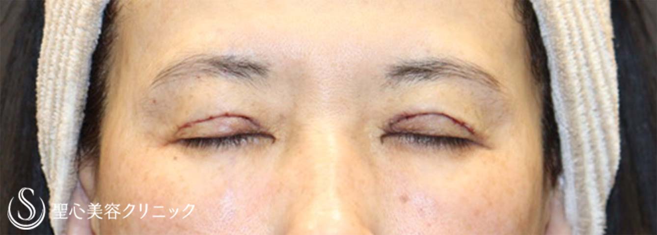 【50代女性・眼瞼下垂手術で目の開きを改善】眼瞼下垂（切開法/挙筋前転法）（手術直後、3ヶ月後） After 