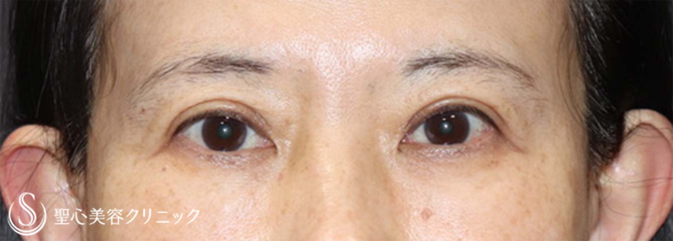 【50代女性・眼瞼下垂手術で目の開きを改善】眼瞼下垂（切開法/挙筋前転法）（手術直後、3ヶ月後） After 