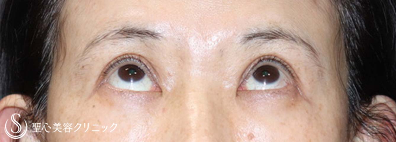 【50代女性・眼瞼下垂手術で目の開きを改善】眼瞼下垂（切開法/挙筋前転法）（手術直後、3ヶ月後） After 