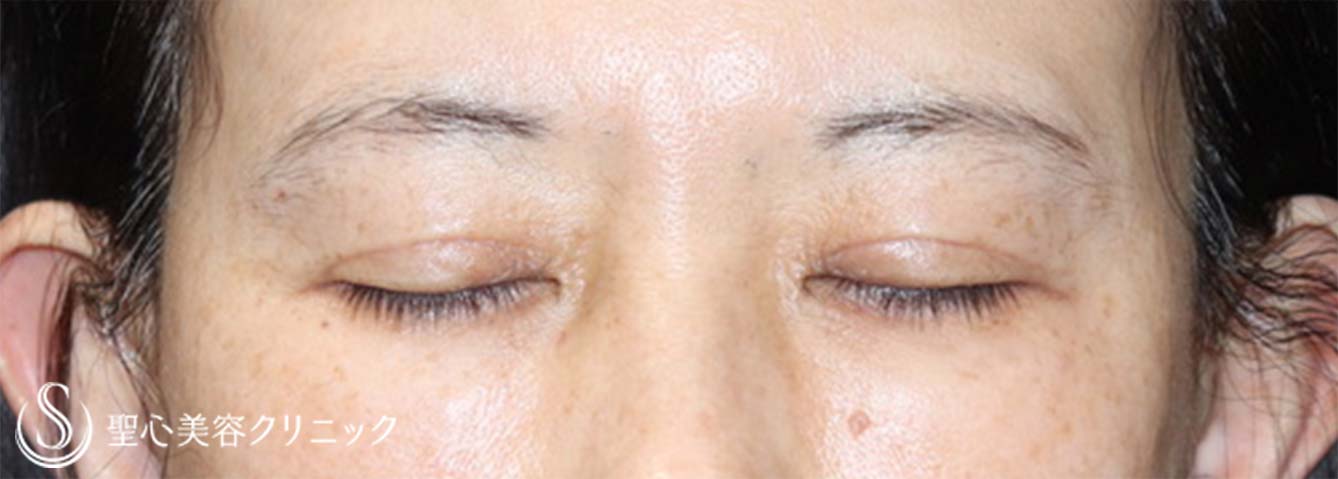 【50代女性・眼瞼下垂手術で目の開きを改善】眼瞼下垂（切開法/挙筋前転法）（手術直後、3ヶ月後） After 