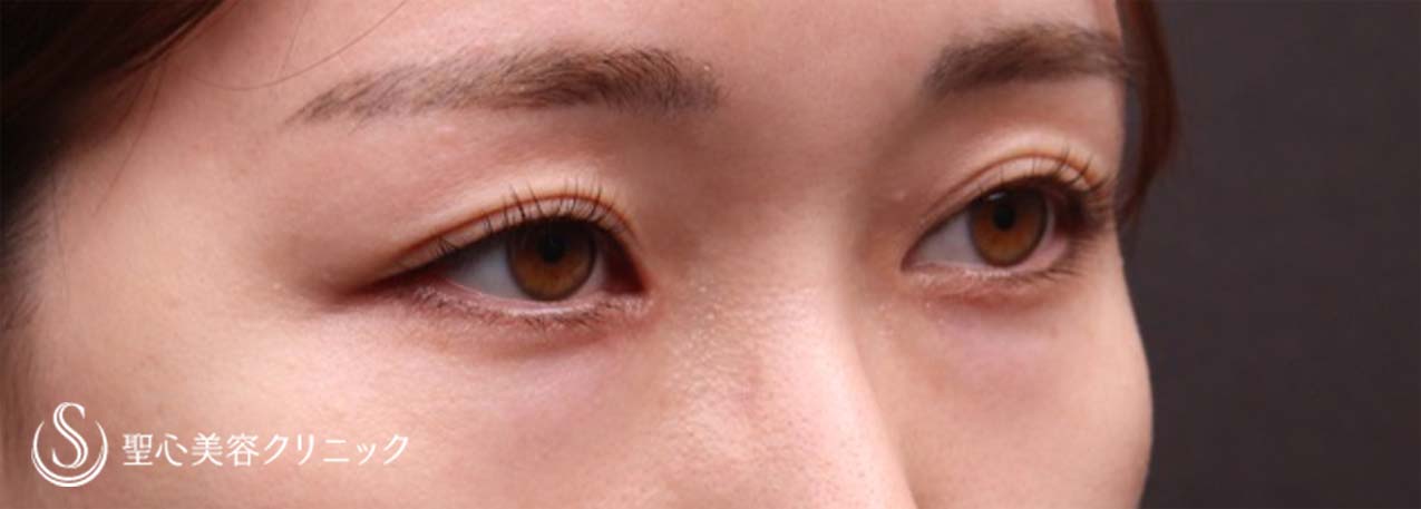 【30代女性・目の下のクマ】経結膜下脱脂術（術後1ヶ月） Before 