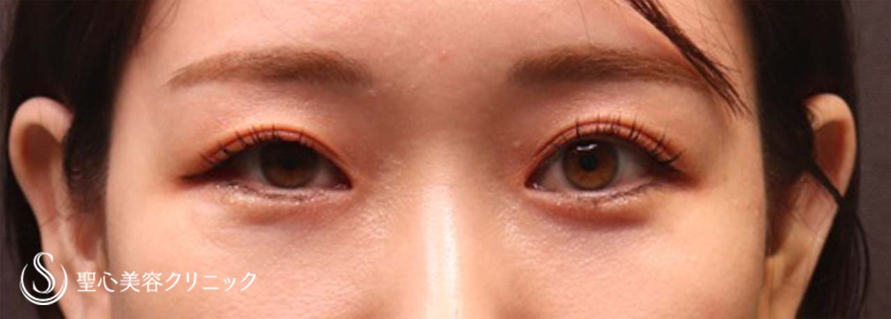 【30代女性・目の下のクマ】経結膜下脱脂術（術後1ヶ月） After 