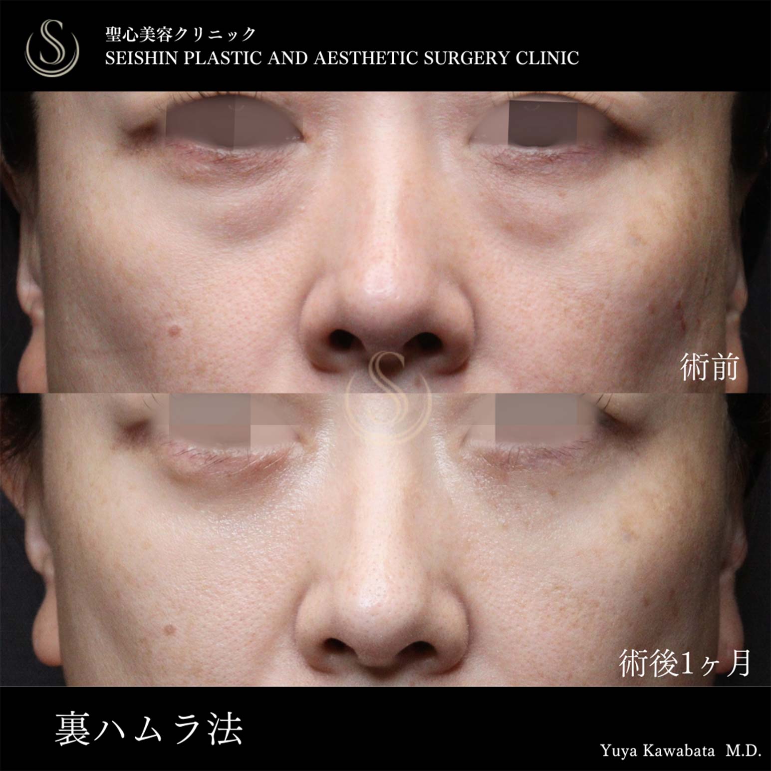 【40代女性・裏ハムラで目の下のくまをすっきり】下眼瞼切開術/下眼瞼除皺術/ハムラ法（術後1ヶ月） Before 