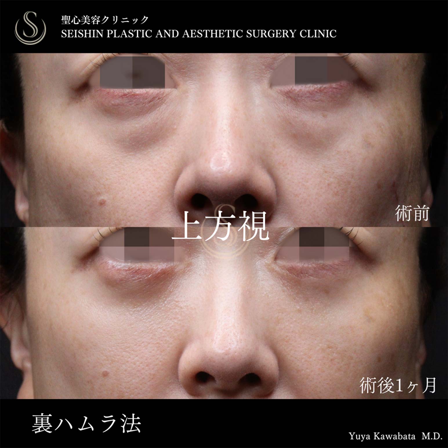 【40代女性・裏ハムラで目の下のくまをすっきり】下眼瞼切開術/下眼瞼除皺術/ハムラ法（術後1ヶ月） After 