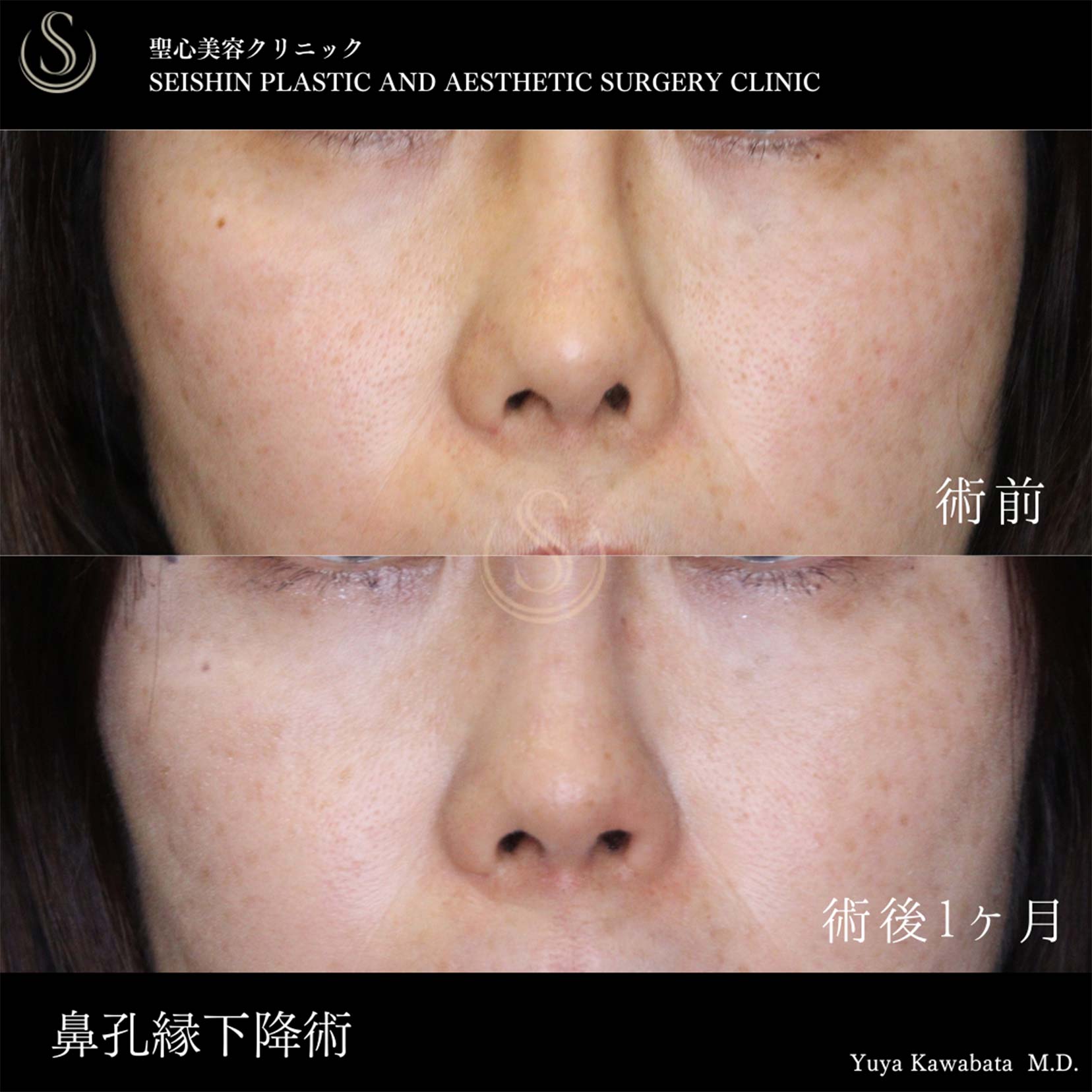 【40代女性・鼻孔縁加工術で鼻の左右差を改善】 鼻孔縁下降術（術後１ヶ月） Before 