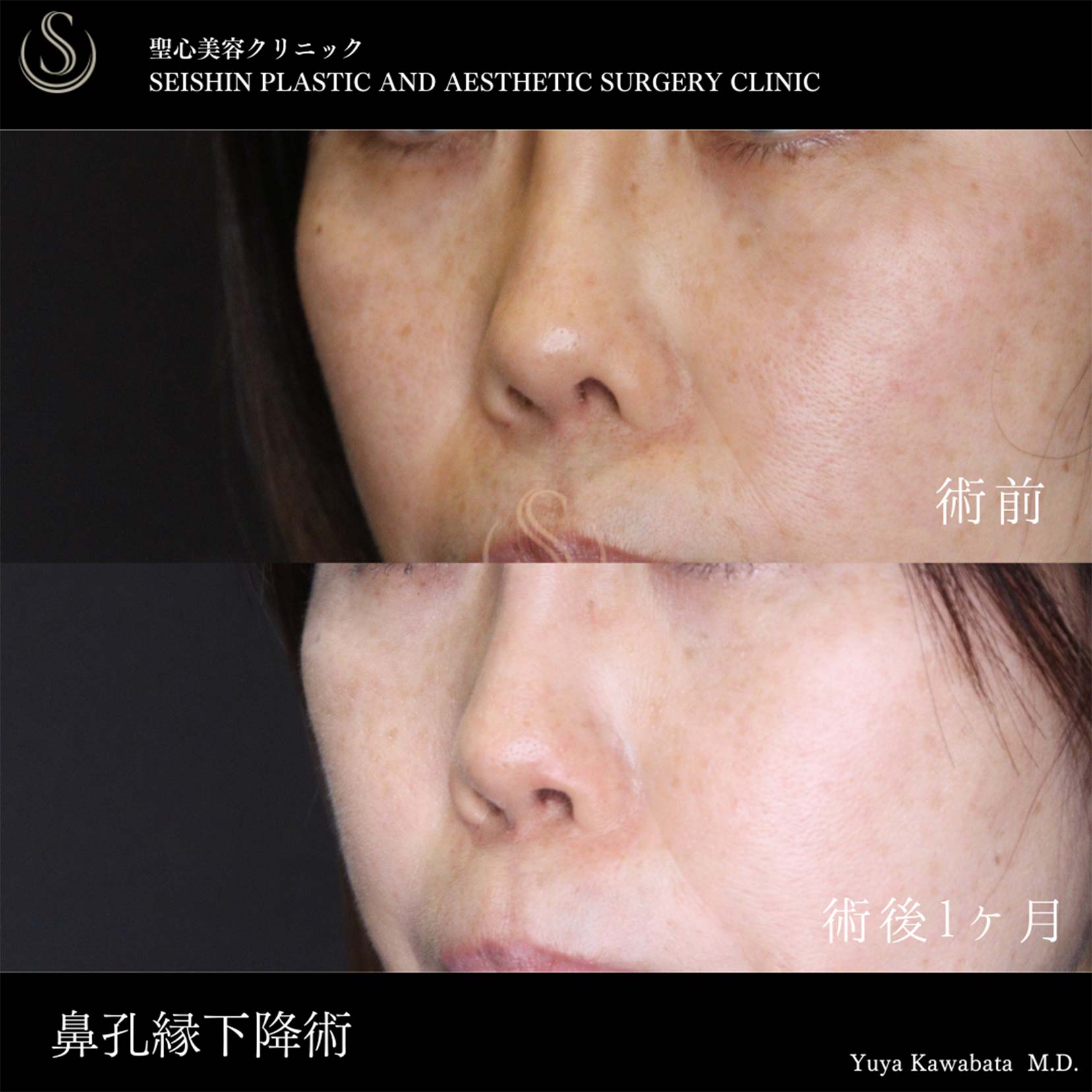 【40代女性・鼻孔縁加工術で鼻の左右差を改善】 鼻孔縁下降術（術後１ヶ月） After 