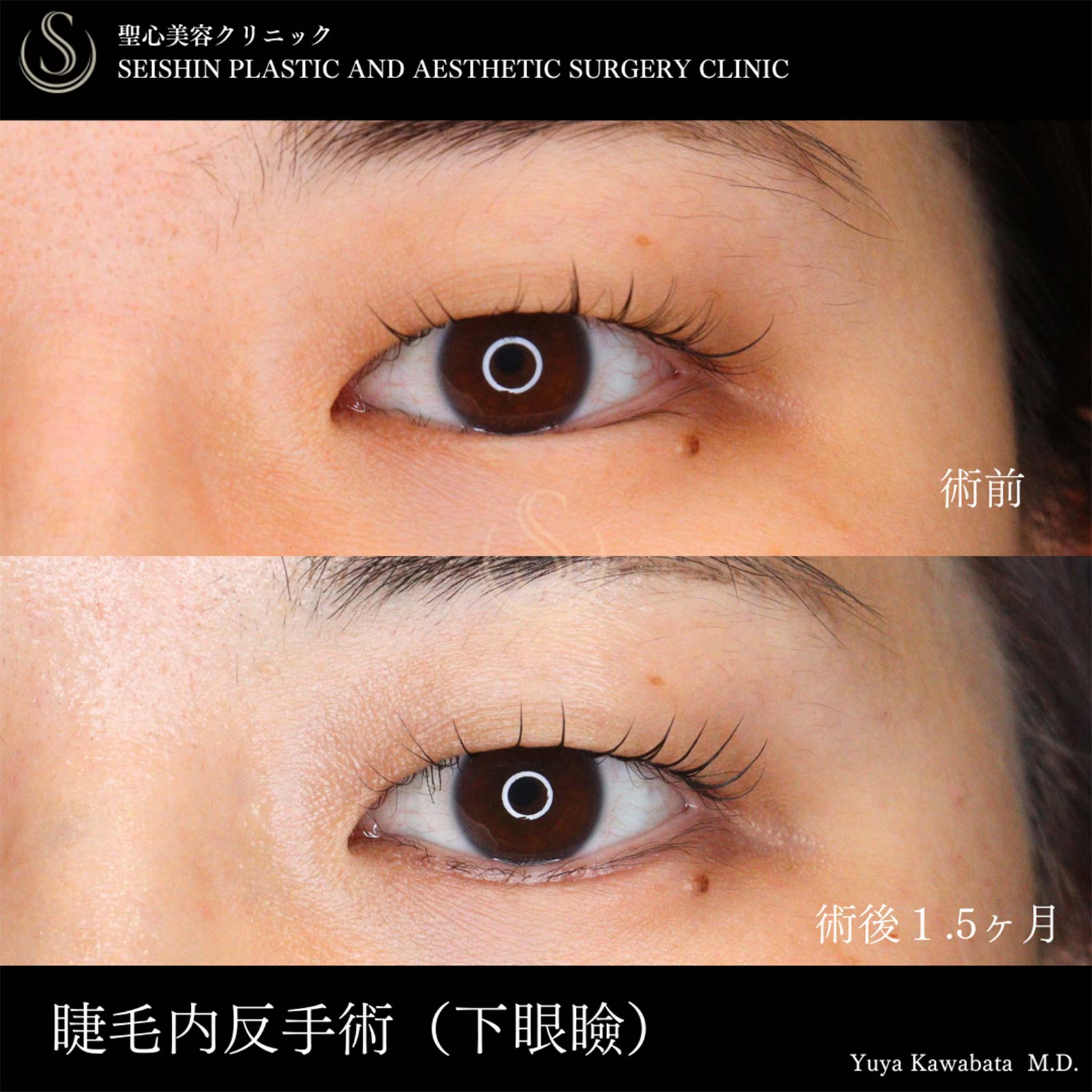 【30代女性・下まつ毛の内反症の矯正】下眼瞼切開術/下眼瞼除皺術/ハムラ法（術後1.5ヶ月） Before 