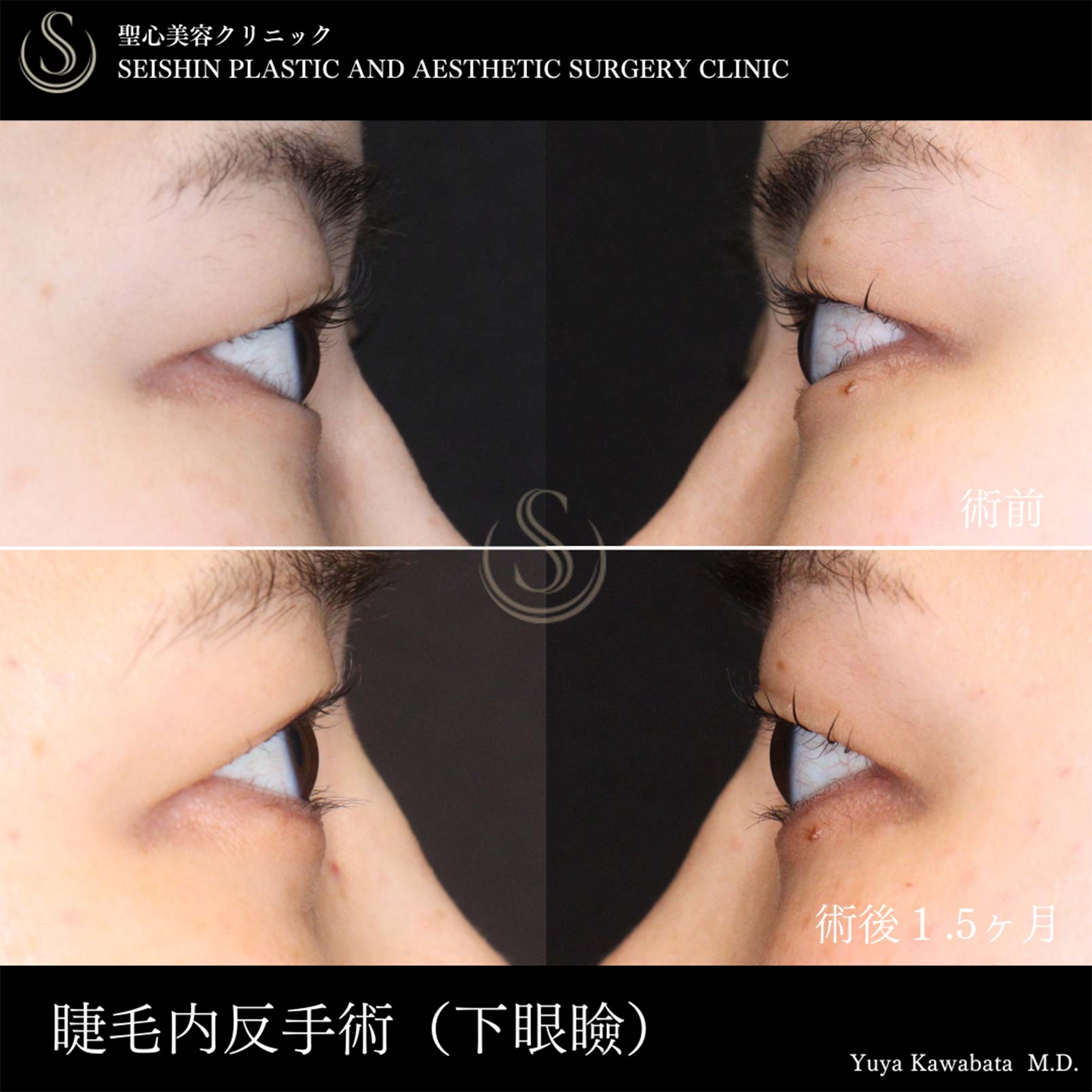 【30代女性・下まつ毛の内反症の矯正】下眼瞼切開術/下眼瞼除皺術/ハムラ法（術後1.5ヶ月） After 