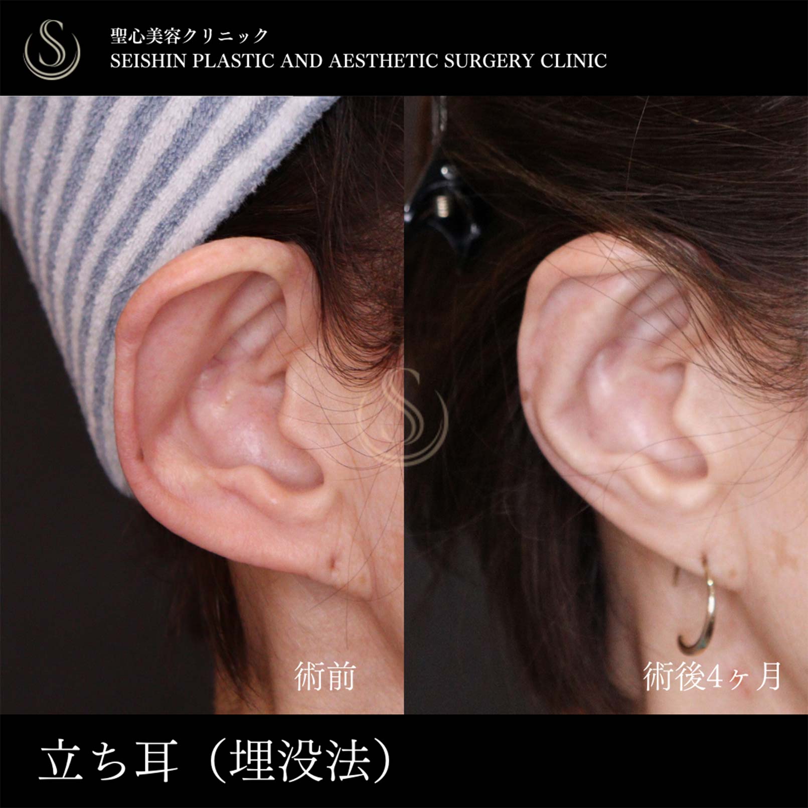 【70代女性・立ち耳を糸で改善】立ち耳修正（埋没法）（術後4ヶ月） Before 