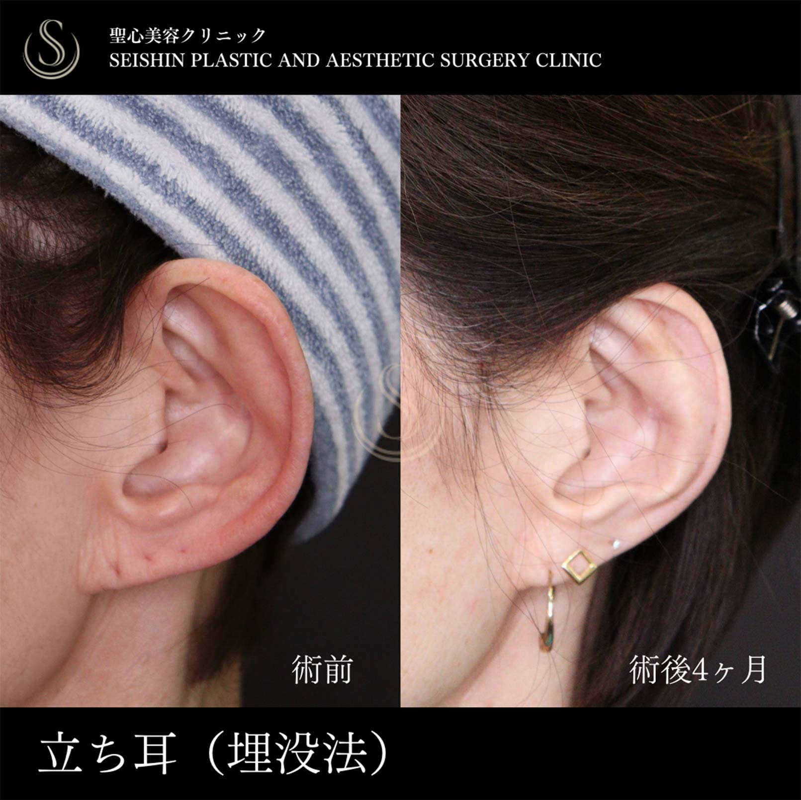 【70代女性・立ち耳を糸で改善】立ち耳修正（埋没法）（術後4ヶ月） After 