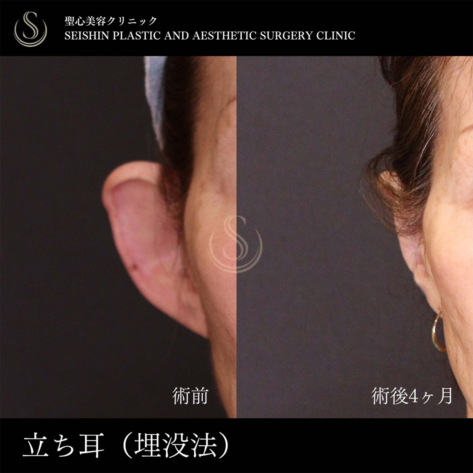 【70代女性・立ち耳を糸で改善】立ち耳修正（埋没法）（術後4ヶ月） After 